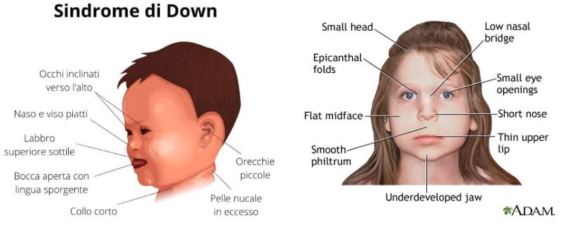 sindrome-fetale-alcol